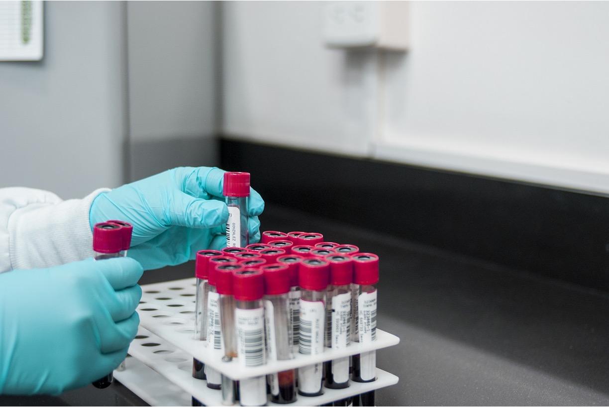 Multigene Urine Test for High-Grade Prostate Cancer Validated in Clinical Study
