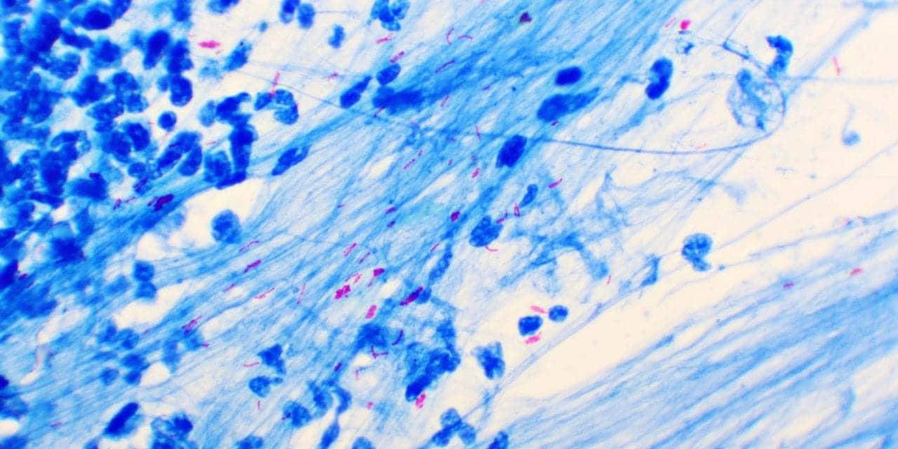 Intelligenome, Cornell Partner on Portable TB Diagnostic